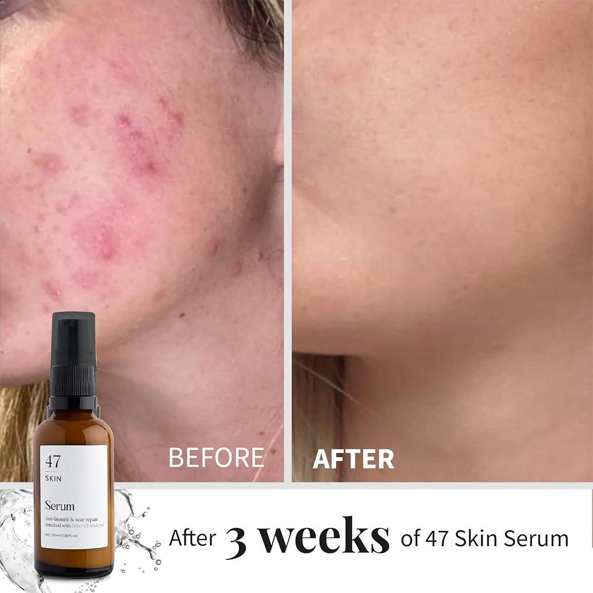 47 Skin Hydrating Face Serum for Clearing Acne and Scars, Anti-Blemish & Scar Repair Serum Skincare Treatment with Silver Chitoderm Smooth Skin Moisturiser Serum for All Skin Types - 30ml - Image 3
