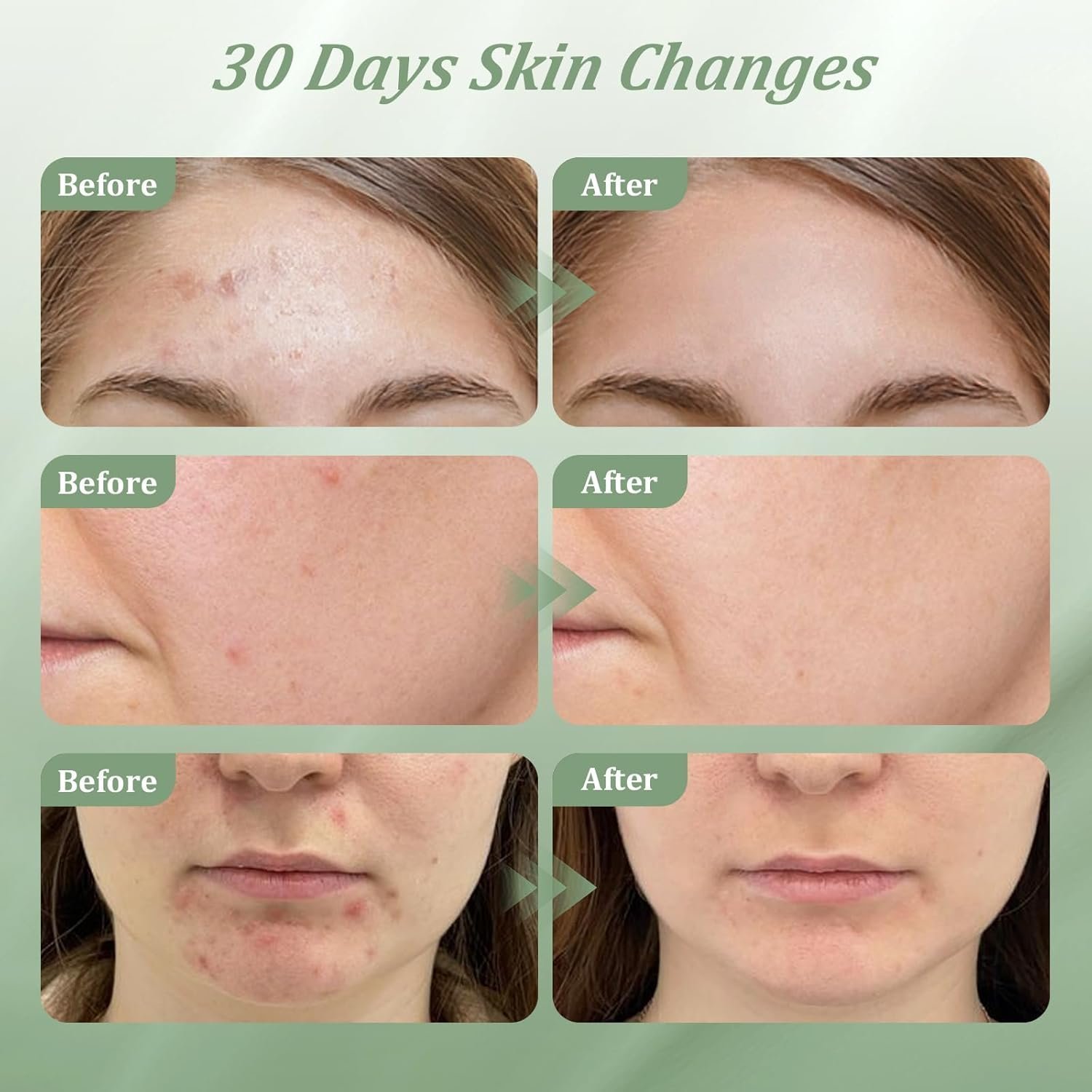 2% Salicylic Acid Acne Treatment Cream for face Back/Butt/Body,Spot Treatment for Pimples, For women and men 30g - Image 6