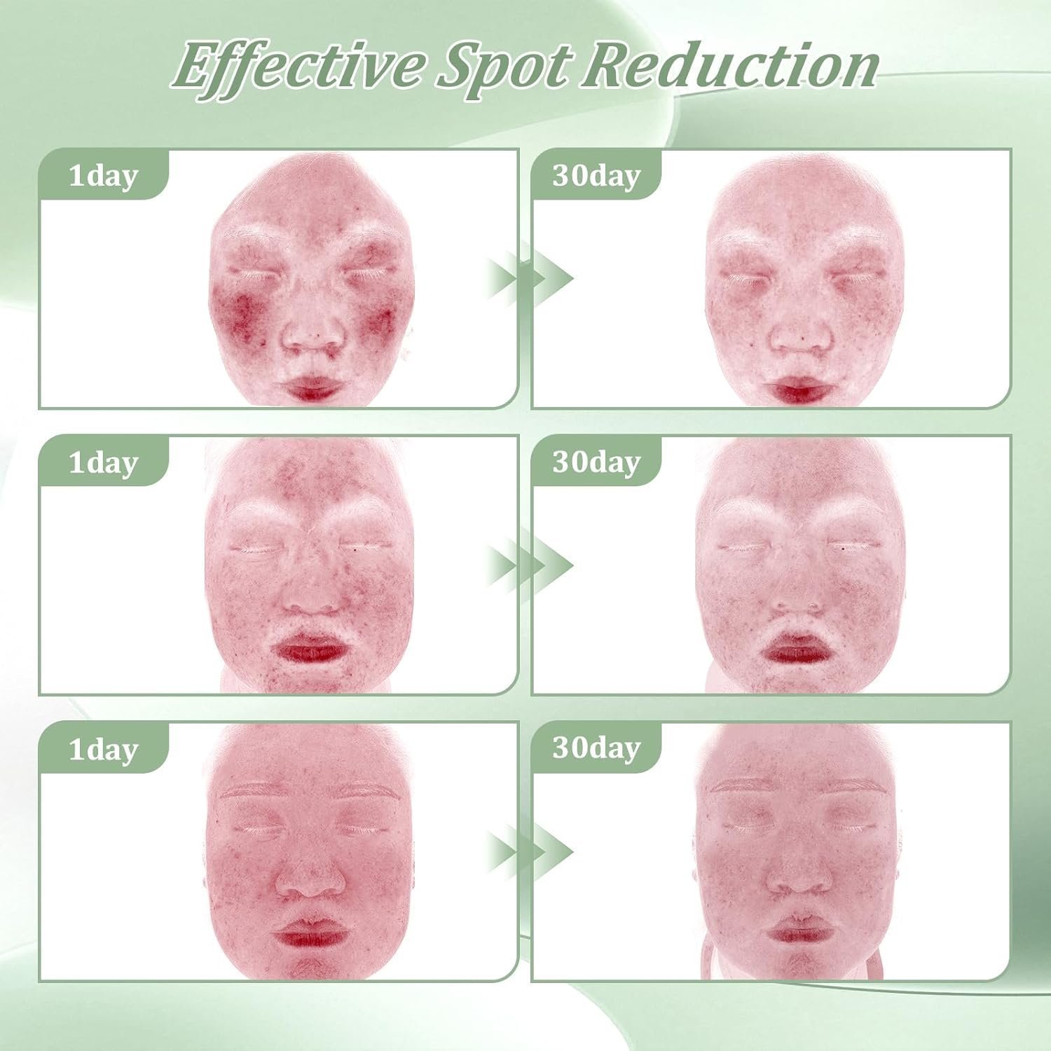 2% Salicylic Acid Acne Treatment Cream for face Back/Butt/Body,Spot Treatment for Pimples, For women and men 30g - Image 3