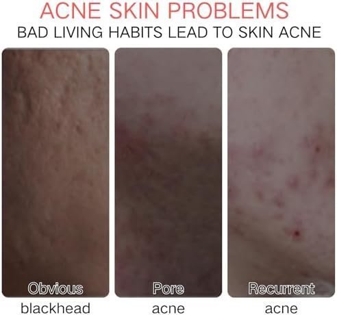 Azelaic Acid 15% Acne Tratment Gel - Spot Treatment for Face - Facial Serum Hydrate,Bright,Smooth Skin - Image 2