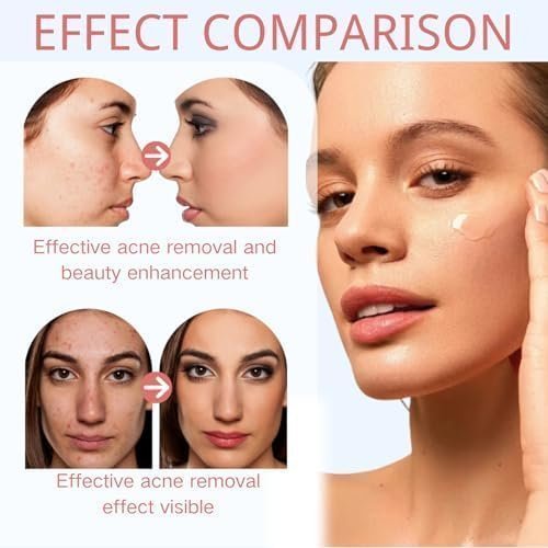 Azelaic Acid 15% Acne Tratment Gel - Spot Treatment for Face - Facial Serum Hydrate,Bright,Smooth Skin - Image 6